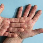 Kasus Campak di Kutai Timur Meningkat, 105 Suspek Tercatat hingga Awal 2026