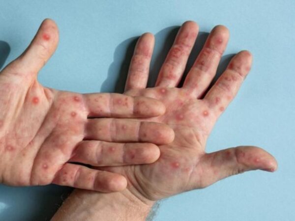 Kasus Campak di Kutai Timur Meningkat, 105 Suspek Tercatat hingga Awal 2026